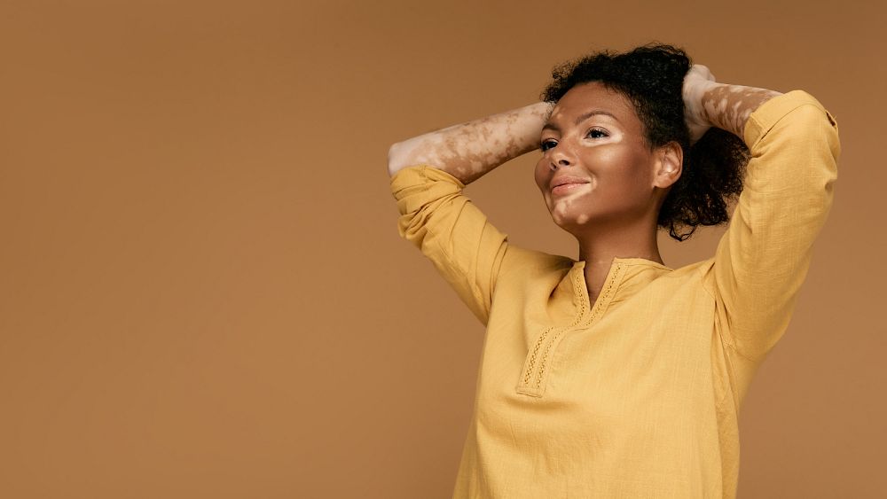 Vitiligo: ‘Miracle cream’ ruxolitinib might be coming to Europe but why is it so controversial?